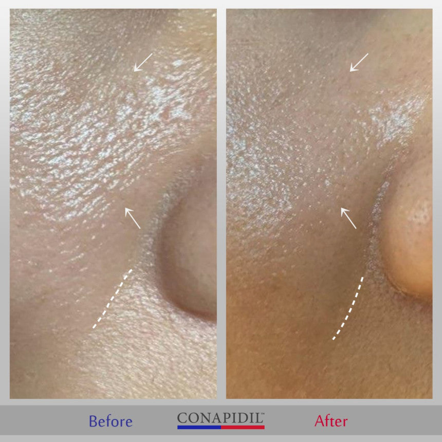 Conapidil Cemenzal Light | High Potency Cream 5000ppm |