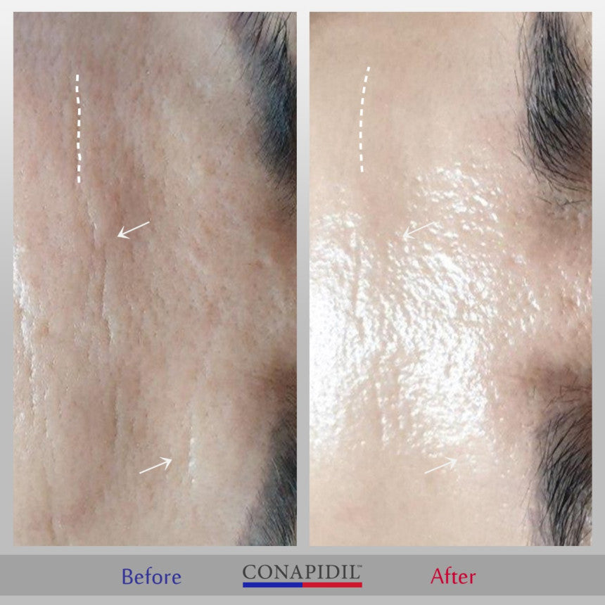 Conapidil Cemenzal Light | High Potency Cream 5000ppm |
