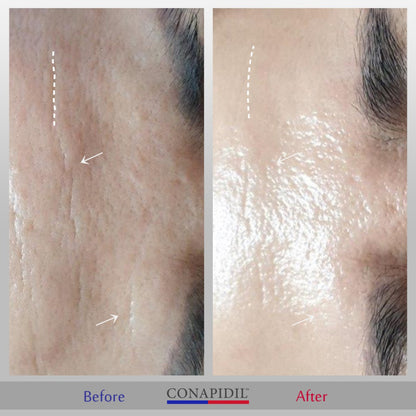 Conapidil Cemenzal Light | High Potency Cream 5000ppm |