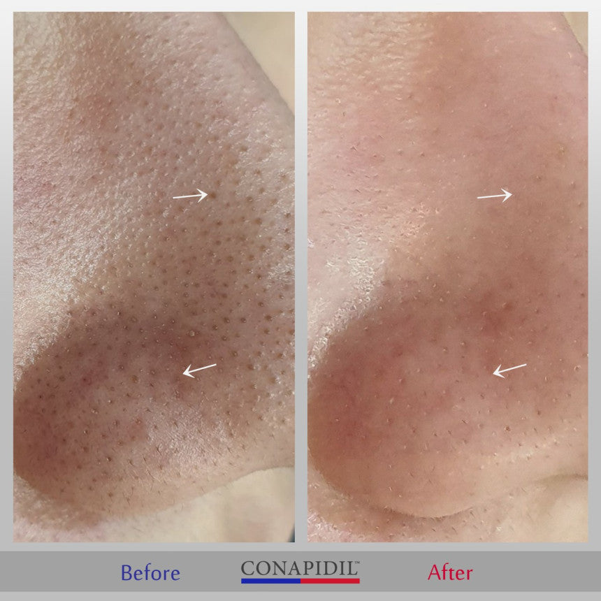 Conapidil Cemenzal Light | High Potency Cream 5000ppm |