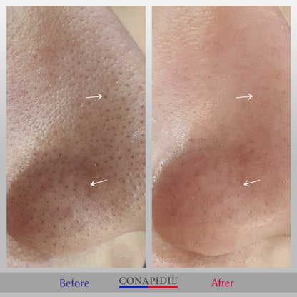 Conapidil Cemenzal Light | High Potency Cream 5000ppm |