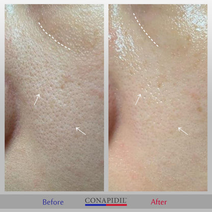 Conapidil Cemenzal Light | High Potency Cream 5000ppm |