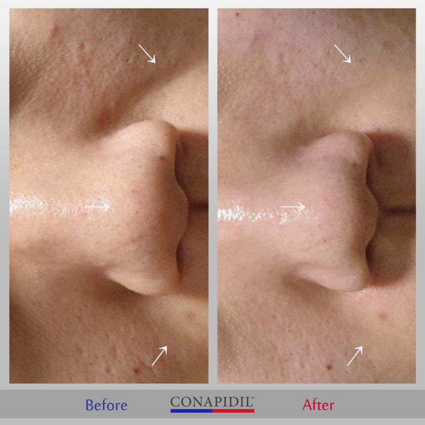 Conapidil Cemenzal Light | High Potency Cream 5000ppm |
