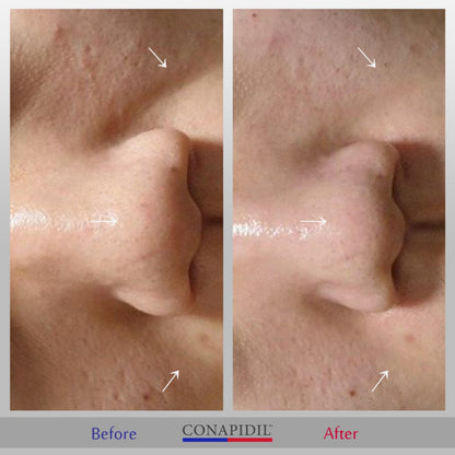 Conapidil Cemenzal Light | High Potency Cream 5000ppm |