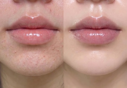 The Plump & Renew Peeling Pack